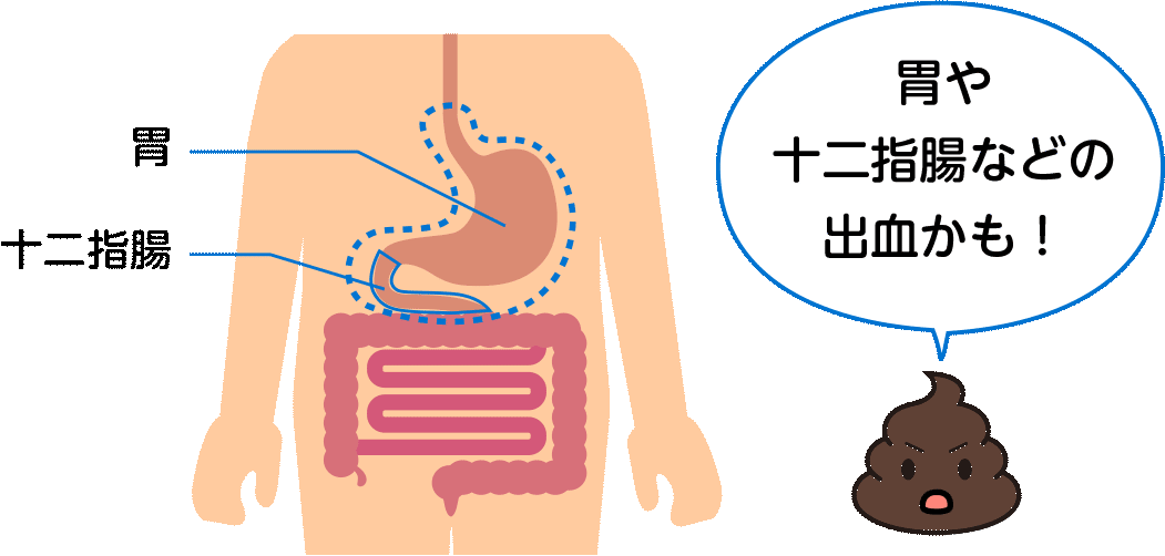 胃や十二指腸と黒い便のイラスト