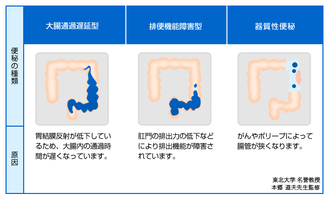 機能性便秘と器質性便秘の種類と原因を示す図