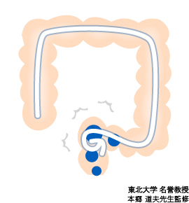 便秘の時の大腸の状態のイラスト