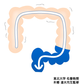 下痢の時の大腸の状態のイラスト