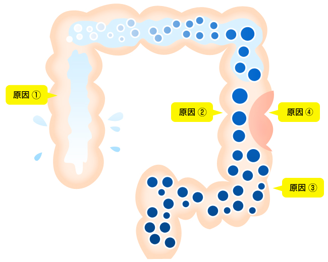 便秘が起こる原因のイラスト
